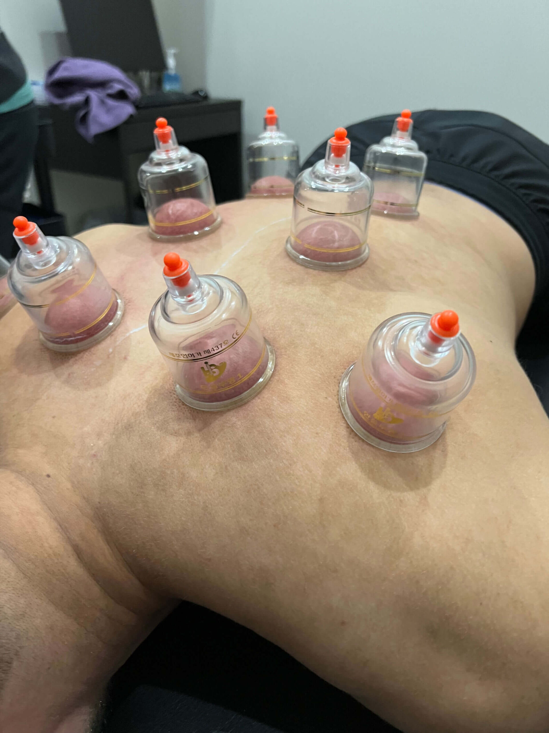 cupping therapy